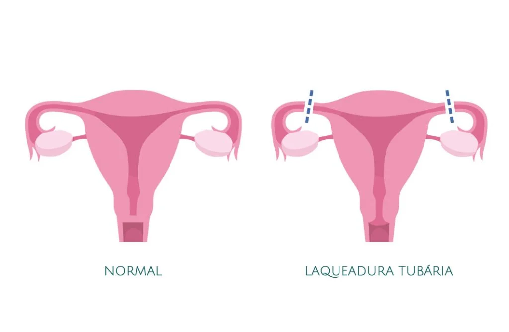 Imagen explicativa de Ligadura Tubaria
